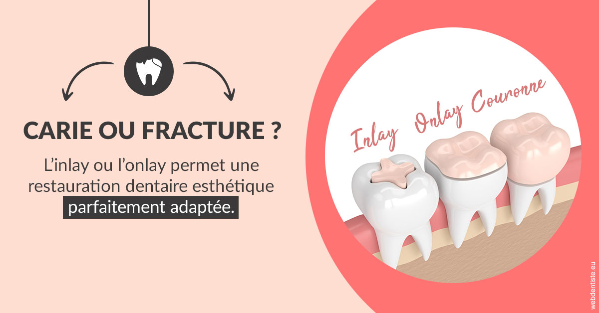 https://www.dentiste-bruxelles-iovleff.be/T2 2023 - Carie ou fracture 2