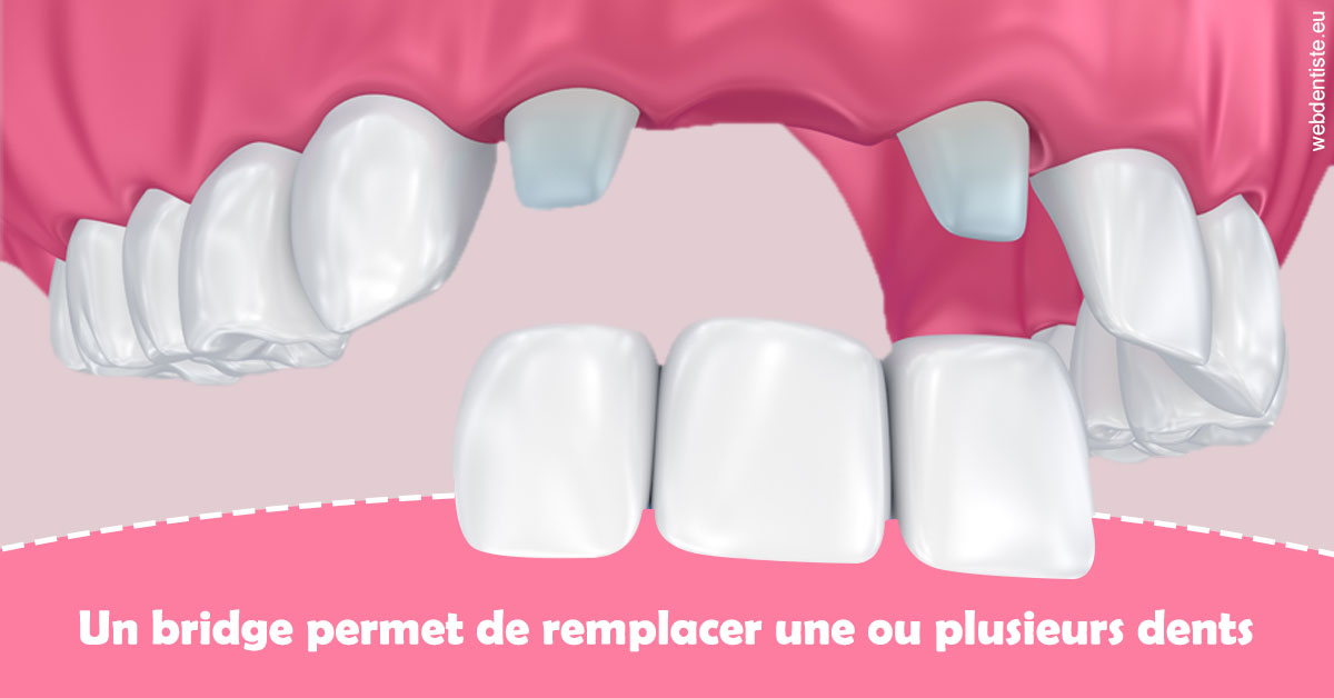 https://www.dentiste-bruxelles-iovleff.be/Bridge remplacer dents 2