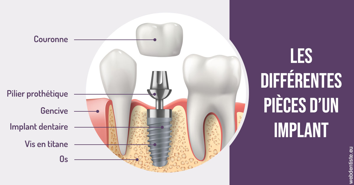 https://www.dentiste-bruxelles-iovleff.be/Les différentes pièces d’un implant 2