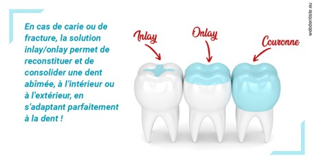 https://www.dentiste-bruxelles-iovleff.be/L'INLAY ou l'ONLAY