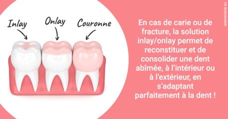 https://www.dentiste-bruxelles-iovleff.be/L'INLAY ou l'ONLAY 2
