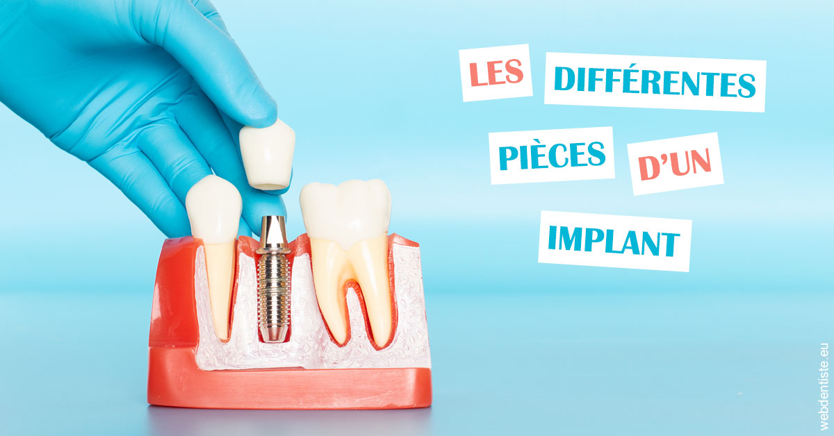https://www.dentiste-bruxelles-iovleff.be/Les différentes pièces d’un implant 2