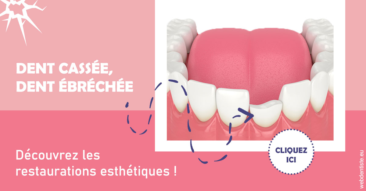 https://www.dentiste-bruxelles-iovleff.be/Dent cassée ébréchée 1